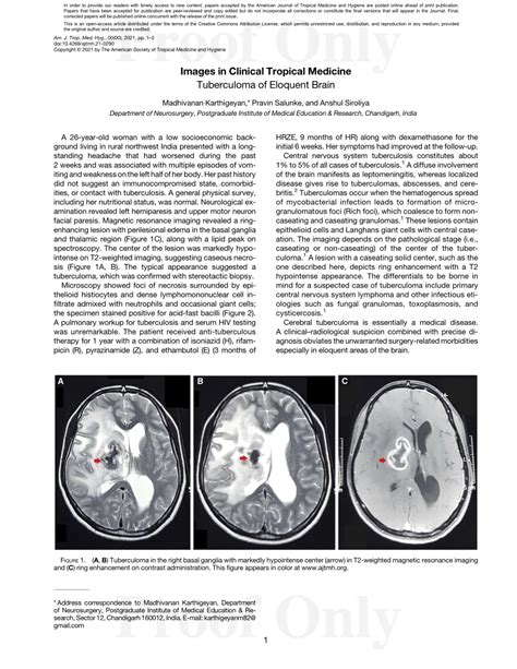 (PDF) Tuberculoma of Eloquent Brain