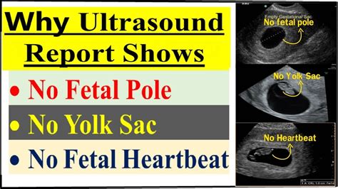 Why Heartbeat Never Comes In Early Pregnancy No Fetal Pole। No Yolk