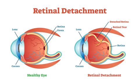 Scleral Buckle Surgery: Procedure, Risks, Results & Recovery