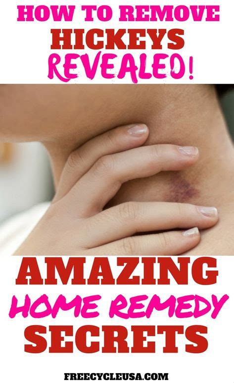 Diy How To Remedy Hickeys How To Get Rid How To Hide Hickeys Get