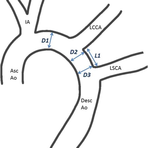 A Common Origin Of The Innominate Artery And Left Common Carotid Download Scientific Diagram