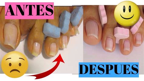 Aprender acerca 51 imagen como eliminar lo amarillo de las uñas