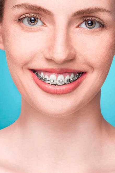 Metal Braces Rochester Pediatric Dentistry And Orthodontics