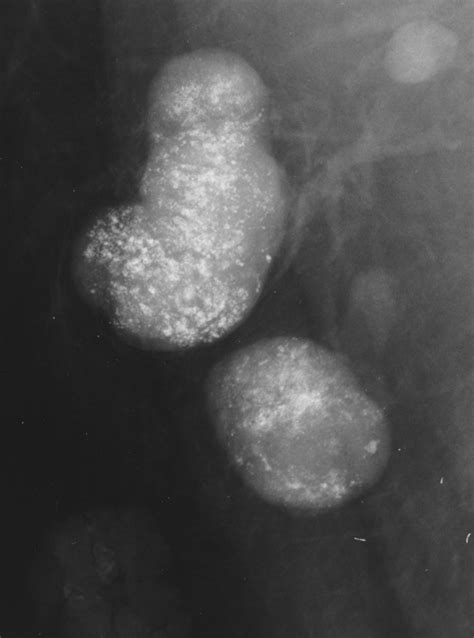 Calcification Of Lymph Nodes