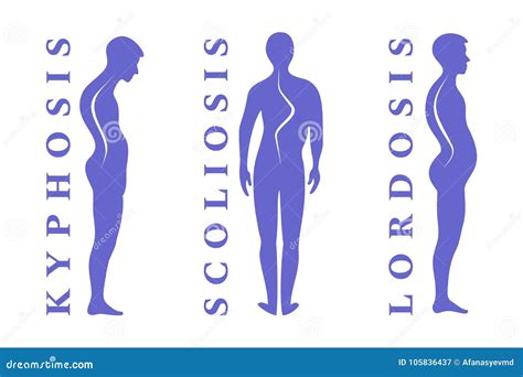 Lordosis Kyphosis And Scoliosis