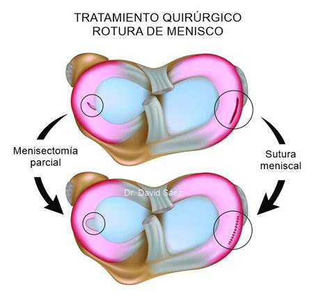 Traumat Logo Especialista En Rotura De Menisco En Madrid