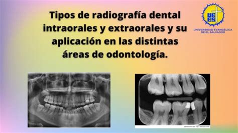 TIPOS DE RADIOGRAFÍAS INTRA0RALES Y EXTRAORALES Y SU APLICACIÓN EN