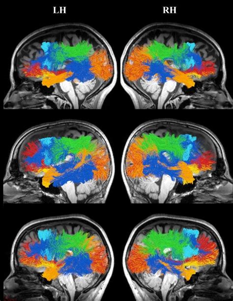 Dorsal And Ventral Tracts Of Interest Shown Are The Bilateral Tracts