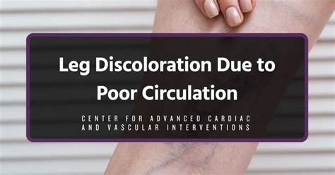 Leg Discoloration Due To Poor Circulation Causes Symptoms And Treatments