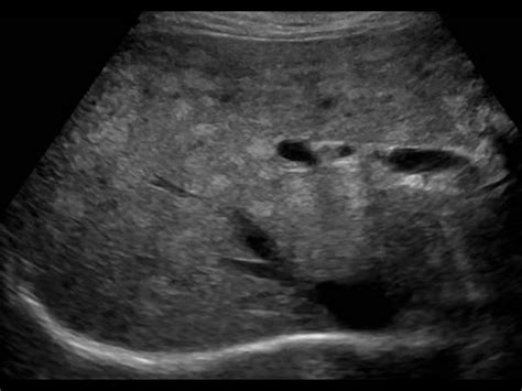 Abdomen And Retroperitoneum 1 1 Liver Case 1 1 11 Fatty Liver And