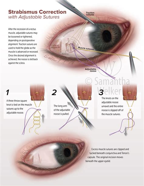 Strabismus Correction Welker Biomedical Media