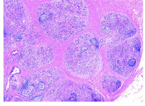 Dense Chronic Inflammation Within Lobules Which Are Separated By