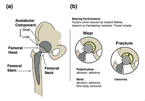 A Schematic Of A Modern Hip Implant B Illustrations Of Issues