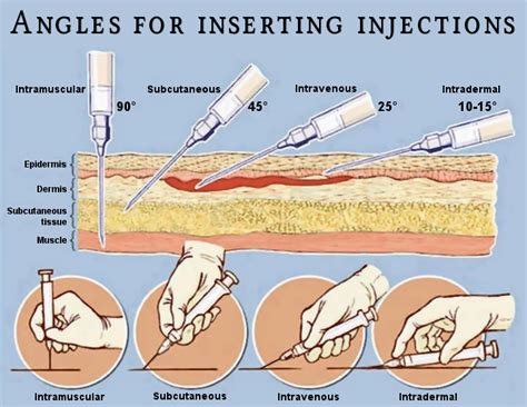 Angle Of Needle For Intramuscular Injection At Doris Glenn Blog