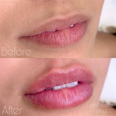 Hyaluronic Acid Lips