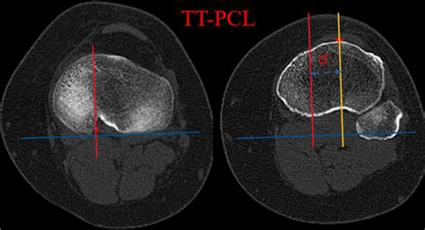 Tt Pcl The Tt Pcl Distance Was Determined As The Mediolateral Distance