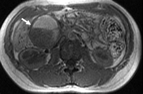 Solid Pseudopapillary Tumor Of The Pancreas Typical And Atypical