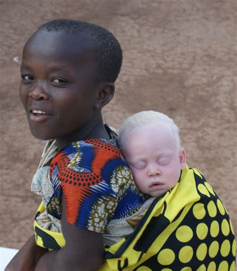 Albino Black Human