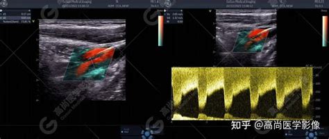 颈动脉狭窄的超声诊断【高尚医学影像】 知乎