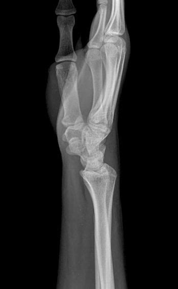 Radiología Lateral Del Puño Y La Mano En Ortopedia Y Traumatología