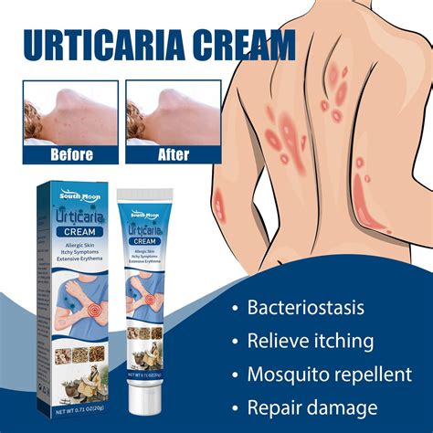 Urticaria Cream Herbal Material Plant Essence Fast Absorption Quickly