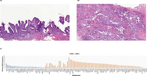 Figures And Data In Gallbladder Adenocarcinomas Undergo Subclonal