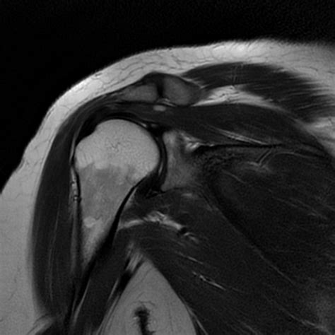 Supraspinatus Tendinosis Image