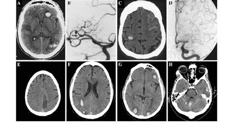 A Right Middle Cerebral Artery Mca Distribution Infarction And