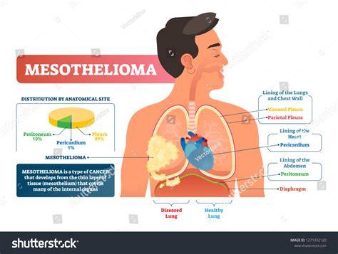 Mesothelioma Vector Illustration Labeled Lung Cancer Stock Vector