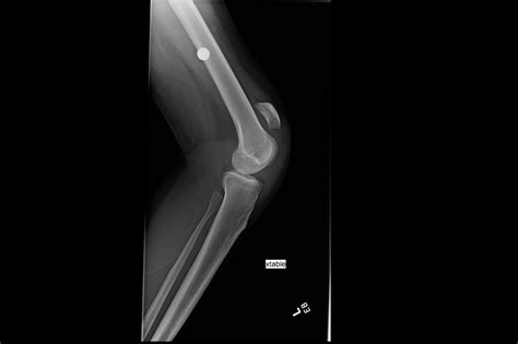 Ortho Dx Pain In The Knee Following A Fall Clinical Advisor