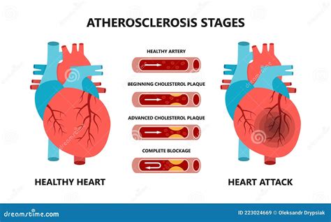 Estadios De Ataque Cardíaco Y Aterosclerosis Arterias Sanas Y No Sanas
