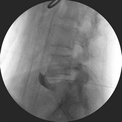 Lateral Fluoroscopic View Of The Lumbosacral Spine Showing The Spread