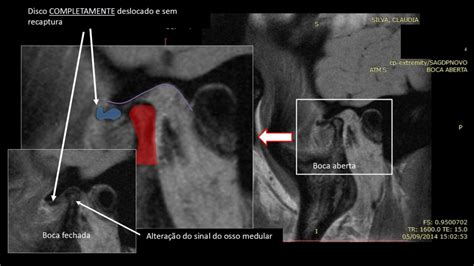 A Cirurgia da ATM é realmente necessária Até para discos deslocados