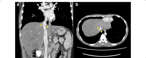 Preoperative Abdominal Computed Tomography Ct Showing The