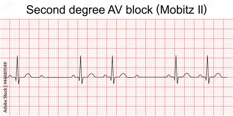 Electrocardiogram Show Second Degree Av Block Mobitz Ii Pattern Ecg