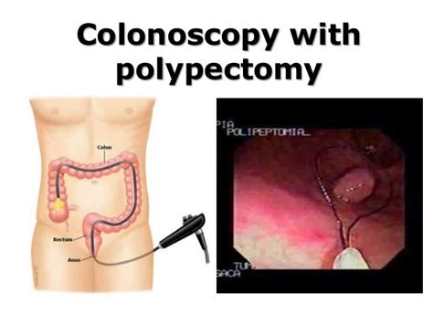 Colonoscopy With Polypectomy