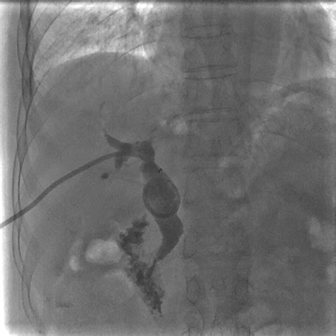 Percutaneous Transhepatic Papillary Balloon Dilation Versus Endoscopic