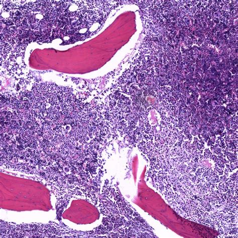 Bone Marrow Biopsy Hypercellular Marrow With Granulocytic