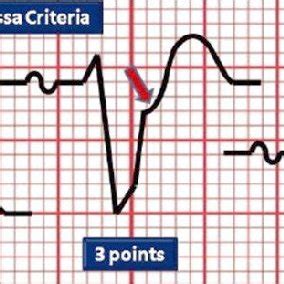 Repeat 12 Lead Electrocardiogram From The Same Patient Following