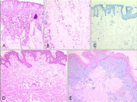 From Plaque Lesion A B Hyperkeratosis And Acanthosis Of The