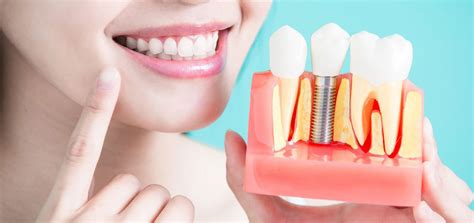 Dental Implant Types Procedures And Cost The Dental Roots