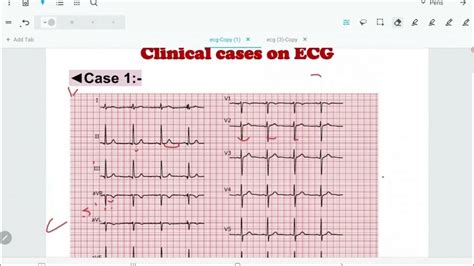 Ecg Part Three سلسة محاضرات ورقة تخطيط القلب الجزء الثالث Youtube