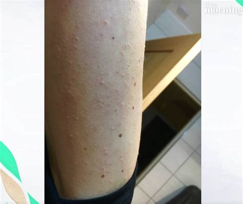 Here's Why Loads Of White Bumps Can Magically Appear On Your Arms And ...