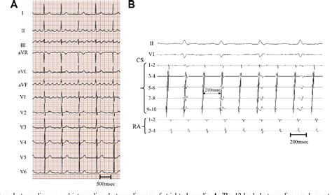 Figure From Perimitral Atrial Flutter With Partial Conduction Block