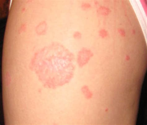 Red Patches On Skin Causes Symptoms Treatment Hubpages