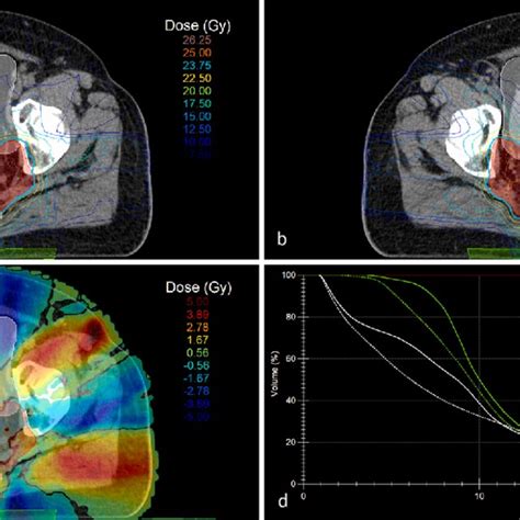 A Slice Of The Planning Ct Scan Of One Of The Patients Showing The