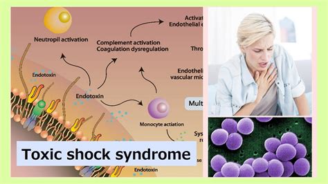 Toxic Shock Syndrome Youtube