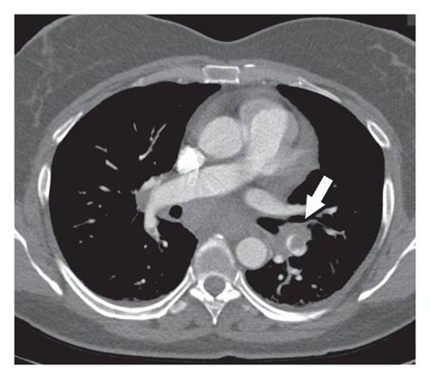 Axial Ct Image Demonstrates Pulmonary Embolism Within The Left