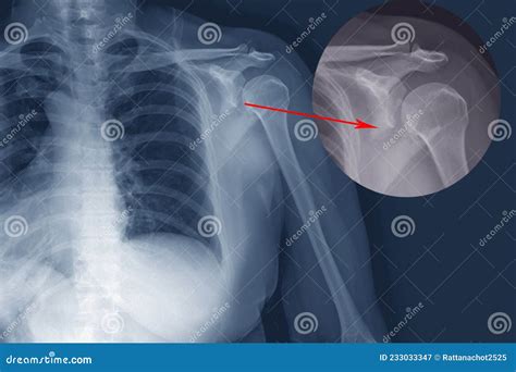 X Ray Shoulder Fracture Posterior Half Of Glenoid With Posterior