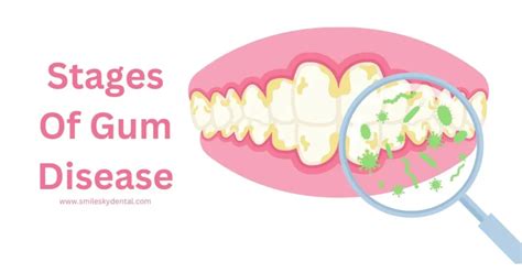 Stages of Gum Disease- Important Symptoms • Dentist in Norcross